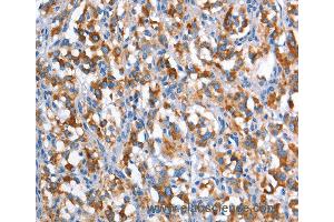 Immunohistochemistry of Human gastric cancer using CD226 Polyclonal Antibody at dilution of 1:60 (CD226 Antikörper)