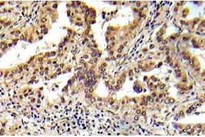 Immunohistochemistry (IHC) analyzes of Tsc2 antibody in paraffin-embedded human prostate carcinoma tissue. (Tuberin Antikörper)