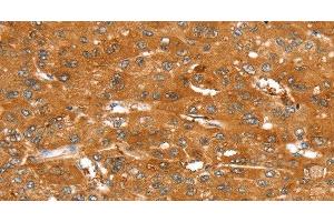 Immunohistochemistry of paraffin-embedded Human liver cancer tissue using ABCC9 Polyclonal Antibody at dilution 1:50 (ABCC9 Antikörper)