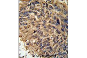 FBXL2 Antibody IHC analysis in formalin fixed and paraffin embedded human lung carcinoma followed by peroxidase conjugation of the secondary antibody and DAB staining. (FBXL2 Antikörper  (C-Term))