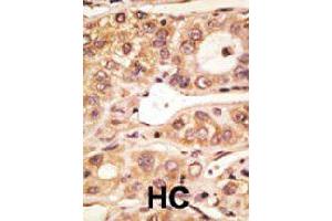 Formalin-fixed and paraffin-embedded human hepatocellular carcinoma tissue reacted with Tlr5 polyclonal antibody  , which was peroxidase-conjugated to the secondary antibody, followed by AEC staining. (TLR5 Antikörper  (C-Term))