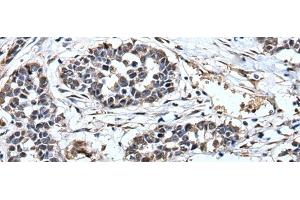 Immunohistochemistry of paraffin-embedded Human esophagus cancer tissue using PRUNE Polyclonal Antibody at dilution of 1:40(x200) (PRUNE Antikörper)