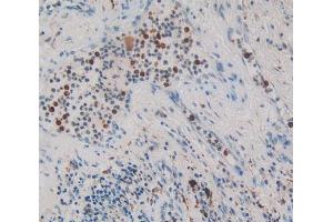IHC-P analysis of lung cancer tissue, with DAB staining. (NUP153 Antikörper  (AA 1238-1468))