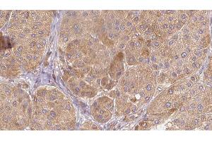 ABIN6277611 at 1/100 staining Human Melanoma tissue by IHC-P. (SEMG1 Antikörper  (C-Term))
