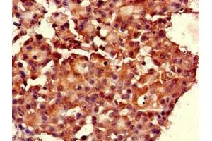 Immunohistochemistry of paraffin-embedded human breast cancer using ABIN7167597 at dilution of 1:100 (RGS19 Antikörper  (AA 1-87))