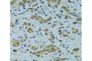 Immunohistochemistry of paraffin-embedded Human gastric cancer using STX1A Polyclonal Antibody at dilution of 1:100 (40x lens). (STX1A Antikörper)