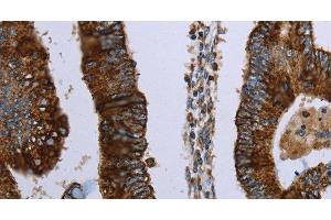 Immunohistochemistry of paraffin-embedded Human colon cancer using HMGCL Polyclonal Antibody at dilution of 1:30 (HMGCL Antikörper)