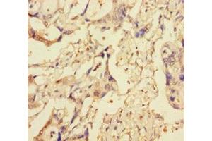 Immunohistochemistry of paraffin-embedded human pancreatic cancer using ABIN7151314 at dilution of 1:100 (XIAP Antikörper  (AA 1-497))
