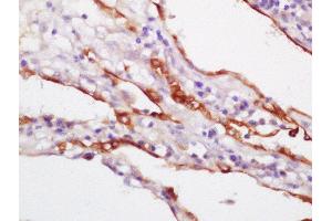 Formalin-fixed and paraffin embedded human lung carcinoma labeled with Rabbit Anti-CK18 Polyclonal Antibody,Unconjugated  at 1:200 followed by conjugation to the secondary antibody and DAB staining (Cytokeratin 18 Antikörper  (AA 301-423))