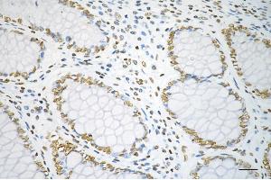 Immunohistochemistry was performed on paraffin-embedded human sigmoid colon carcinoma using TAF15 antibody (ABIN7800503), 1:200).