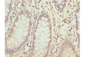 Immunohistochemistry of paraffin-embedded human colon cancer using ABIN7176363 at dilution of 1:100 (ZNF544 Antikörper  (AA 1-230))