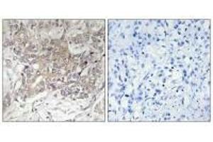 Immunohistochemistry analysis of paraffin-embedded human liver carcinoma tissue using GCNT3 antibody. (GCNT3 Antikörper)