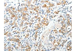 The image on the left is immunohistochemistry of paraffin-embedded Human gastric cancer tissue using (TEP1 Antibody) at dilution 1/40, on the right is treated with synthetic peptide. (TEP1 Antikörper)