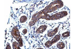 IHC-P Image BCAR1 antibody [N2C2], Internal detects BCAR1 protein at cytoplasm on human breast carcinoma by immunohistochemical analysis. (BCAR1 Antikörper  (Internal Region))