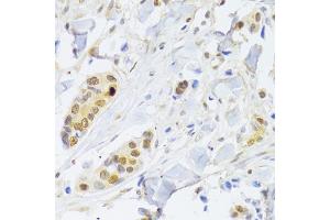 Immunohistochemistry of paraffin-embedded human breast cancer using RELA Antibody. (NF-kB p65 Antikörper)