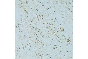Immunohistochemistry of paraffin-embedded human uterine cancer using NHEJ1 antibody. (NHEJ1 Antikörper)