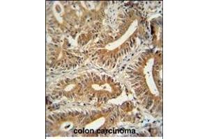 CCD antibody (C-term) (ABIN654259 and ABIN2844079) immunohistochemistry analysis in formalin fixed and paraffin embedded human colon carcinoma followed by peroxidase conjugation of the secondary antibody and DAB staining. (CEP89 Antikörper  (C-Term))