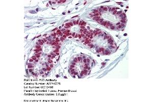 Rabbit Anti-FUS Antibody  Paraffin Embedded Tissue: Human Breast Antibody Concentration: 5 ug/ml (FUS Antikörper  (N-Term))