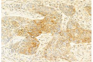 ABIN6264192 and ABIN6269201 at 1/100 staining Human lung cancer by IHC-P.