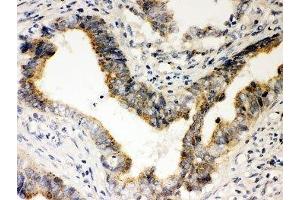 IHC-P: Rad51 antibody testing of human intestine cancer tissue (RAD51 Antikörper  (AA 1-258))