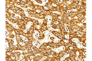 ABIN6258317 and ABIN6274726 at 1/100 staining Human liver cancer and adjacent normal tissues by IHC-P. (MRPL10 Antikörper  (C-Term))