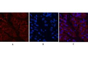 Immunofluorescence analysis of human stomach cancer tissue. (beta Catenin Antikörper)