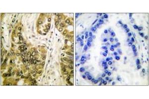 Immunohistochemistry analysis of paraffin-embedded human lung carcinoma tissue, using Galectin 3 Antibody. (Galectin 3 Antikörper  (AA 141-190))