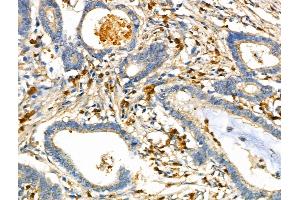 ABIN6261639 and ABIN6276641 at 1/100 staining Human gastric cancer by IHC-P. (F11R Antikörper  (C-Term))