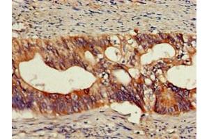 Immunohistochemistry of paraffin-embedded human colon cancer using ABIN7161673 at dilution of 1:100 (Olfactomedin 1 Antikörper  (AA 374-441))