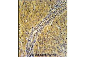DYNC1LI2 Antibody immunohistochemistry analysis in formalin fixed and paraffin embedded human cervix carcinoma followed by peroxidase conjugation of the secondary antibody and DAB staining. (DYNC1LI2 Antikörper  (AA 152-180))