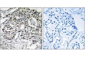 Immunohistochemistry analysis of paraffin-embedded human breast carcinoma, using PXMP2 Antibody. (PXMP2 Antikörper  (AA 38-87))