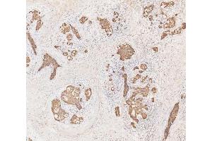 IHC analysis of Cytokeratin 19 using anti-Cytokeratin 19 antibody (ABIN3043288).