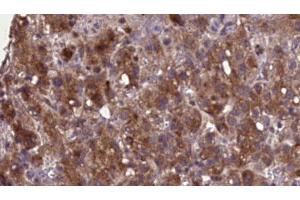 ABIN6276896 at 1/100 staining Human liver cancer tissue by IHC-P.