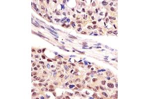 Antibody staining UCHL1 in human lung adenocarcinoma tissue sections by Immunohistochemistry (IHC-P - paraformaldehyde-fixed, paraffin-embedded sections). (UCHL1 Antikörper  (C-Term))