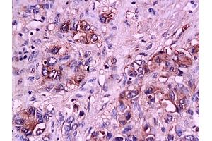 Formalin-fixed and paraffin embedded human gastric carcinoma tissue labeled with Anti-E-Selectin Polyclonal Antibody, Unconjugated (ABIN674244) at 1:200 followed by conjugation to the secondary antibody and DAB staining (Selectin E/CD62e Antikörper  (AA 501-612))