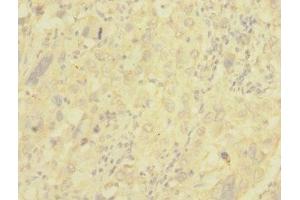 Immunohistochemistry of paraffin-embedded human liver cancer using ABIN7147644 at dilution of 1:100 (NG2 Antikörper  (AA 1950-2210))