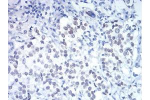 Immunohistochemical analysis of paraffin-embedded bladder cancer tissues using DDX5 mouse mAb with DAB staining. (DDX5 Antikörper  (AA 475-614))