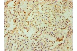 Immunohistochemistry of paraffin-embedded human breast cancer using ABIN7149890 at dilution of 1:100