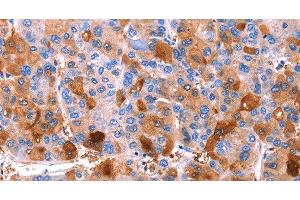 Immunohistochemistry of paraffin-embedded Human liver cancer tissue using ERN2 Polyclonal Antibody at dilution 1:40 (ERN2 Antikörper)