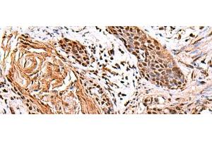 Immunohistochemistry of paraffin-embedded Human esophagus cancer tissue using ITPR2 Polyclonal Antibody at dilution of 1:65(x200) (ITPR2 Antikörper)