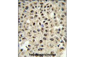 Formalin-fixed and paraffin-embedded human hepatocarcinoma reacted with SSB Antibody (N-term), which was peroxidase-conjugated to the secondary antibody, followed by DAB staining. (SSB Antikörper  (N-Term))
