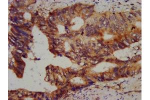 IHC image of ABIN7147529 diluted at 1:800 and staining in paraffin-embedded human colon cancer performed on a Leica BondTM system. (CHMP5 Antikörper  (AA 1-219))