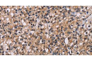 Immunohistochemistry of paraffin-embedded Human prostate cancer using GNL3 Polyclonal Antibody at dilution of 1:60 (Nucleostemin Antikörper)
