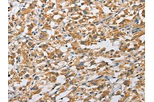 The image on the left is immunohistochemistry of paraffin-embedded Human thyroid cancer tissue using ABIN7128493(ARHGAP5 Antibody) at dilution 1/25, on the right is treated with fusion protein. (ARHGAP5 Antikörper)