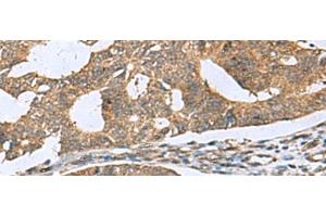 Immunohistochemistry of paraffin-embedded Human colorectal cancer tissue using RPL18 Polyclonal Antibody at dilution of 1:70(x200) (RPL18 Antikörper)
