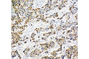 IHC-P: Peroxiredoxin 3 antibody testing of human breast cancer tissue