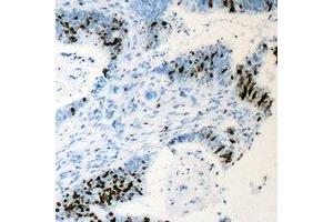 Immunohistochemical analysis of Cyclin C staining in human colon cancer formalin fixed paraffin embedded tissue section. (Cyclin C Antikörper)