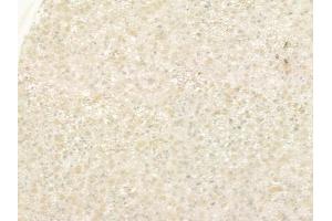 ABIN6257387 and ABIN6275304 at 1/100 staining human astrocytoma by IHC-P. (Neuromedin U Antikörper  (C-Term))
