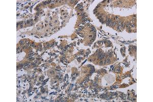Immunohistochemistry of Human cervical cancer using CCL1 Polyclonal Antibody at dilution of 1:50 (CCL1 Antikörper)