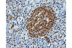 Immunohistochemical staining of paraffin-embedded Adenocarcinoma of breast tissue using anti-BRAF mouse monoclonal antibody. (BRAF Antikörper)